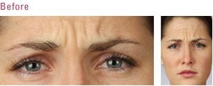 Botox before and after