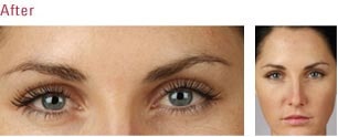Utah Botox Before and After