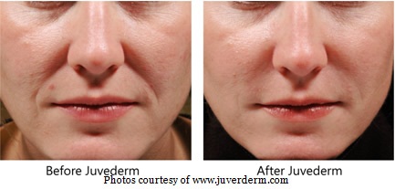 Juvederm utah
